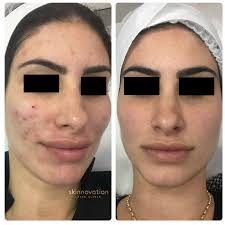 It is trusted by practitioners worldwide. Laser Skin Rejuvenation Archives Skinnovation Laser Clinic