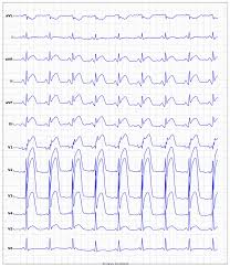 Image result for ST Elevation