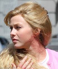 Julianne hough is speaking her truth! Julianne Hough Pictured With Horrific Burn On The Set Of Her New Film With Russell Brand Daily Mail Online