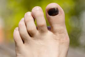 The skin on the surface may break down and look scraped. Black Toenail 6 Potential Causes