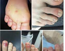 Learn the word for kuku jari kaki and other related vocabulary in american english so that you can talk about lebih banyak tentang bagian tubuh with confidence. Lesi Pada Jari Kaki Pasien Covid 19 Bisa Lama Sembuhnya Republika Online