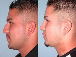 Nose surgery before and after male. Nose Surgery Santa Rosa Rhinoplasty Artemedica