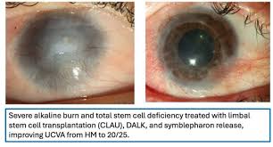 Image result for Dry Eye