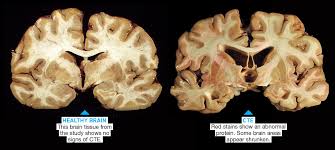 (7 sep 2017) what is cte? Brain Trauma Investigator Cool Stem Jobs Article For Students Scholastic Science World Magazine
