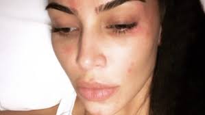 29,532 likes · 3,126 talking about this. Schuppenflechte Im Gesicht Kim Kardashian Zeigt Sich Ungeschminkt N Tv De