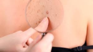 D'autres signes et symptômes du mélanome. Cancers De La Peau Depister Pour Mieux Traiter Hopital Erasme