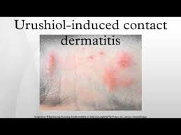 Image result for Rhus Dermatitis