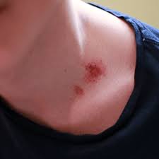 Wash it off again with warm water and follow it twice a day. How To Get Rid Of A Hickey How To Get Rid Of Stuff
