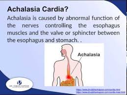 Laparoscopic Surgery For Achalasia Cardia In Gurgaon Laparoscopic Surgery Surgery Hemorrhoids