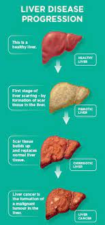 Primary liver cancer is where the cancer originates in the liver. Primary Liver Cancer Symptoms Diagnosis And Treatment