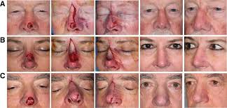 Update your find a dermatologist profile, the academy's directory that's visited by over 1 million people a year. Nasal Flap Archives Skin Cancer And Reconstructive Surgery Center