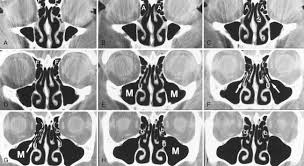 Carlson nasal, oral & laryngeal cavities, illustration ss21310241. Radiology Of The Nasal Cavity And Paranasal Sinuses Ento Key