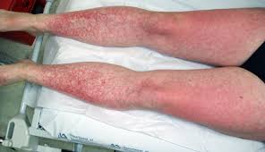 Dress Syndrome Cutaneous Rashes Skin Rash Steven Johnson Syndrome Rash Treatment
