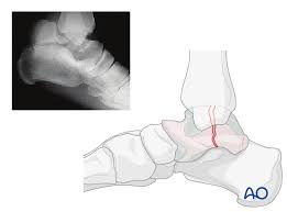 Image result for Talus Fracture
