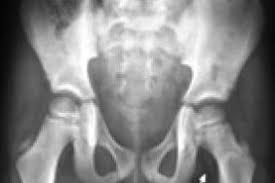 Check spelling or type a new query. Rhume De Hanches Contes Et Legendes Pediatrie Pratique