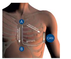 Il defibrillatore cardiaco serve a cercare di evitare la morte dell'individuo con arresto cardiaco. Emblem S Icd System Boston Scientific