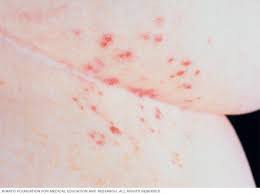 Image result for scabies in the groin area