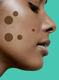 Looks like a perfect dot until you look very closely and it has almost like a star shape. 9 Dark Spot Treatments That Really Work According To Dermatologists Self