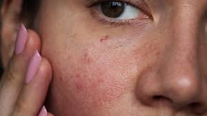 Image result for demodex rosacea