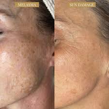 Image result for Melasma