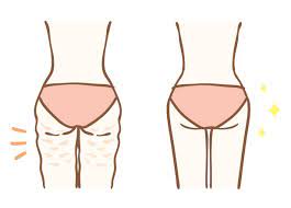 3.200+ Cellulite Illustrazioni, grafiche vettoriali royalty-free e clip art  - iStock | Woman body, Dieta, Anticellulite