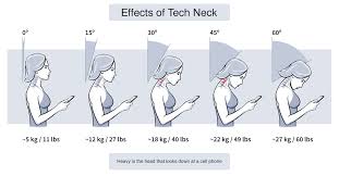 Tech neck epidemic: How to treat the rise in chronic neck pain | Back and  Spine | Orthopaedics | Rehabilitation | UT Southwestern Medical Center