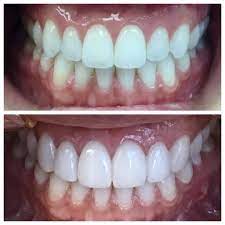 Dental veneers do not require any special care. Dr Veytsman Porcelain Veneers Mimic A Natural Smile To Enhance The Whole Face