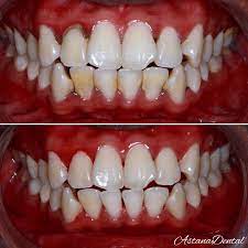 Implan gigi adalah solusi buat kamu yang ingin mengganti gigi yang hilang. Scaling Untuk Buang Astana Dental Wangsa Melawati Facebook