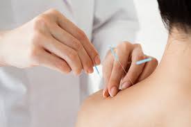 Image result for Acupuncture