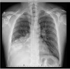 Abnormalities on chest radiographs may be suggestive of, but are never diagnostic of tb, but can be used to rule out pulmonary tb. Endobronchial Tuberculosis In An Immunocompetent Young Filipino Male A Case Report From Kingdom Of Saudi Arabia