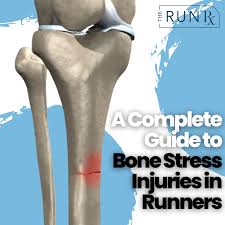 Image result for Tibia Stress Fracture