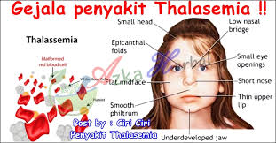 Ciri Ciri Penyakit Thalasemia
