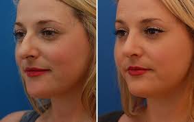 The Best Place For Non Surgical Nose Job Near Me Nose Job Nose Surgery Rhinoplasty