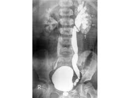 Image result for Voiding Cystourethrogram