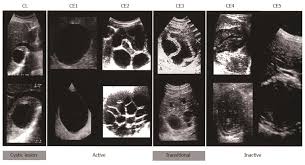 We did not find results for: Cystic Echinococcosis Of The Liver A Primer For Hepatologists