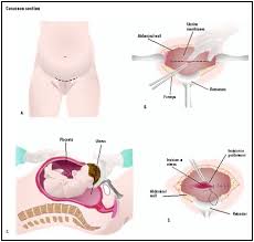 Cesarean Section Baby Average Definition Purpose Description Risks Normal Results