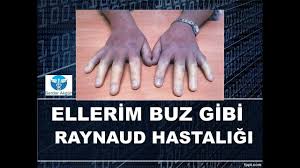 Ellerim Buz Gibi Raynaud Hastaligi Youtube Videolar