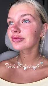 𝑭𝒓𝒆𝒔𝒉 𝒐𝒇𝒇 𝒕𝒉𝒆 𝒏𝒆𝒆𝒅𝒍𝒆 ! 💕 Mayra Gamboa BSN , RN ✨ 📲To  book call