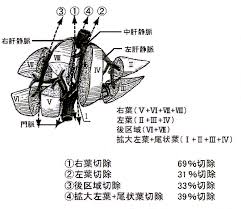 生体肝移植手術方法