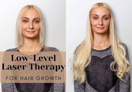 It is fda 501 cleared and thus it is safe to use, at least do no harm to our body. Low Level Laser Therapy For Hair Growth What You Should Know