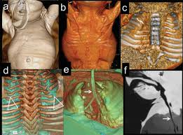 We did not find results for: Bell Shaped Chest Is Demonstrated With Small Upper Chest Musculature Download Scientific Diagram