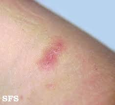 Image result for scabies in the groin area