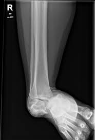 Image result for Subtalar Dislocation
