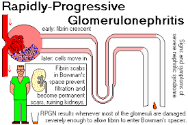Rapidly Progressive Glomerulonephritis Nursing Mnemonics Nursing Fun Medical Laboratory Science