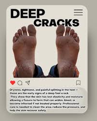 Image result for Onychotillomania feet