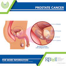 Prostate - Robert Boissoneault Oncology Institute