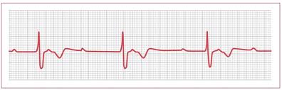 Check spelling or type a new query. Third Degree Av Block Medlibes Online Medical Library
