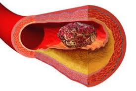 Antikoagulantien pass pdf | antikoagulantien sind arzneistoffe, die die blutgerinnung verlangsamen. Antikoagulantien Gegen Dickes Blut Therapie Medikamente Derstandard At Gesundheit