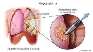 Even getting a biopsy of the tumors does not always work because mesothelioma tumors look like other cancer tumors. Mesothelioma