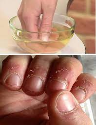 Home Remedy For Hangnails My Hijab Nail Remedies Beauty Hacks Hair And Nails